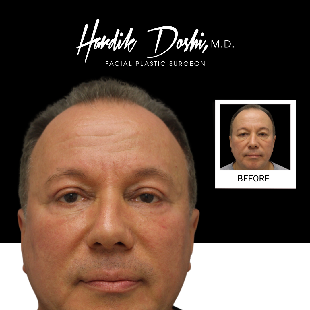 Eyes Before & After Photos Dr. Hardik Doshi