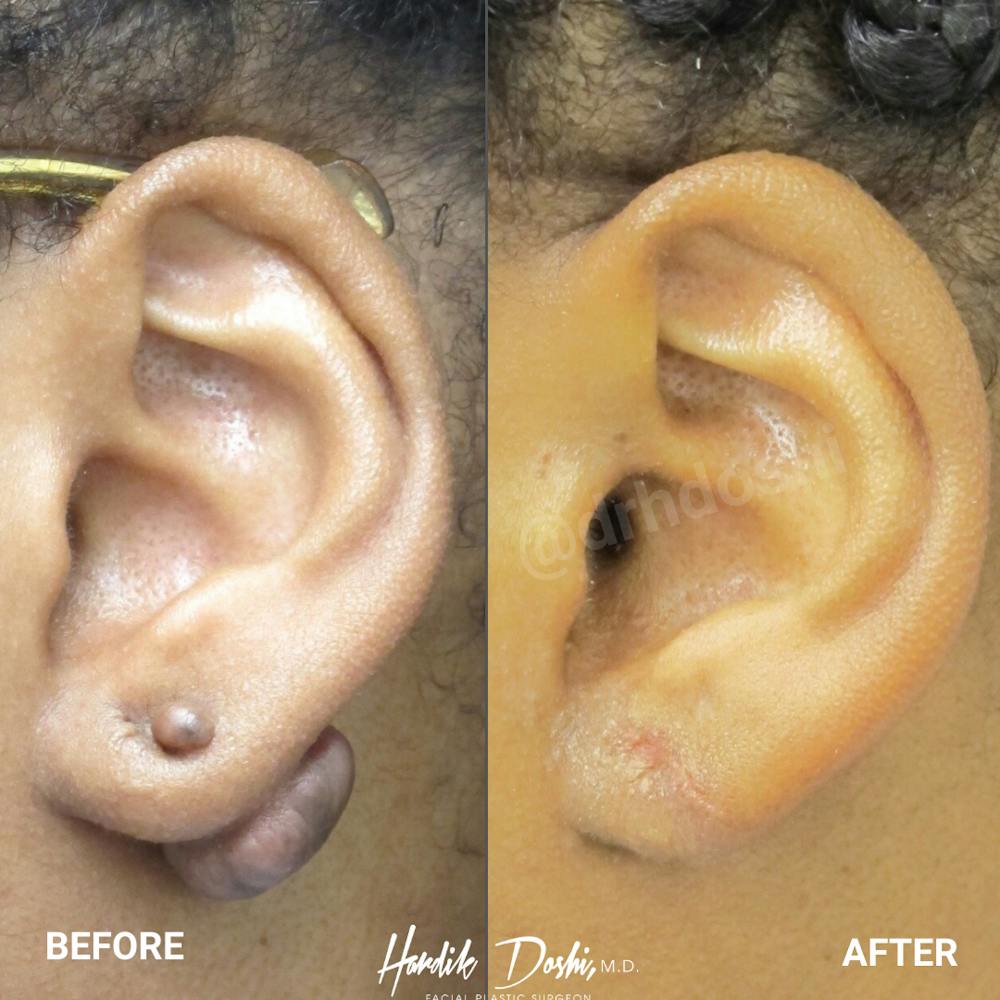 Ears Gallery - Patient 108744088 - Image 1