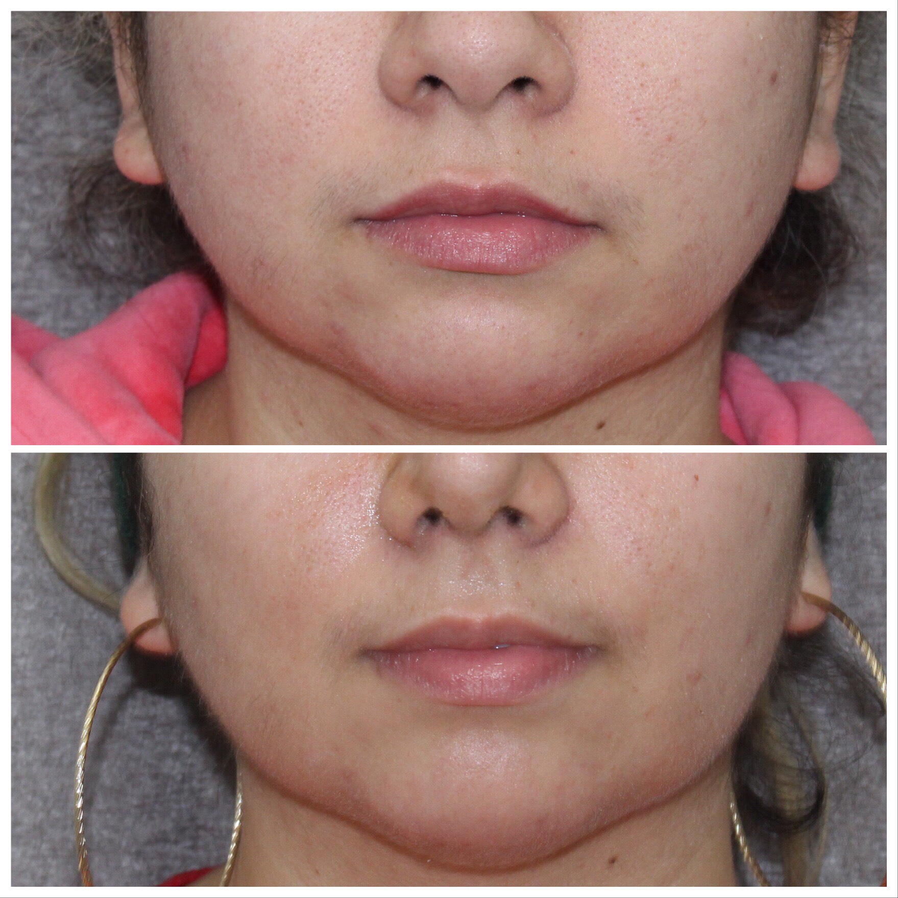 B&A Buccal Fat Gallery Dr. Hardik Doshi in Brooklyn