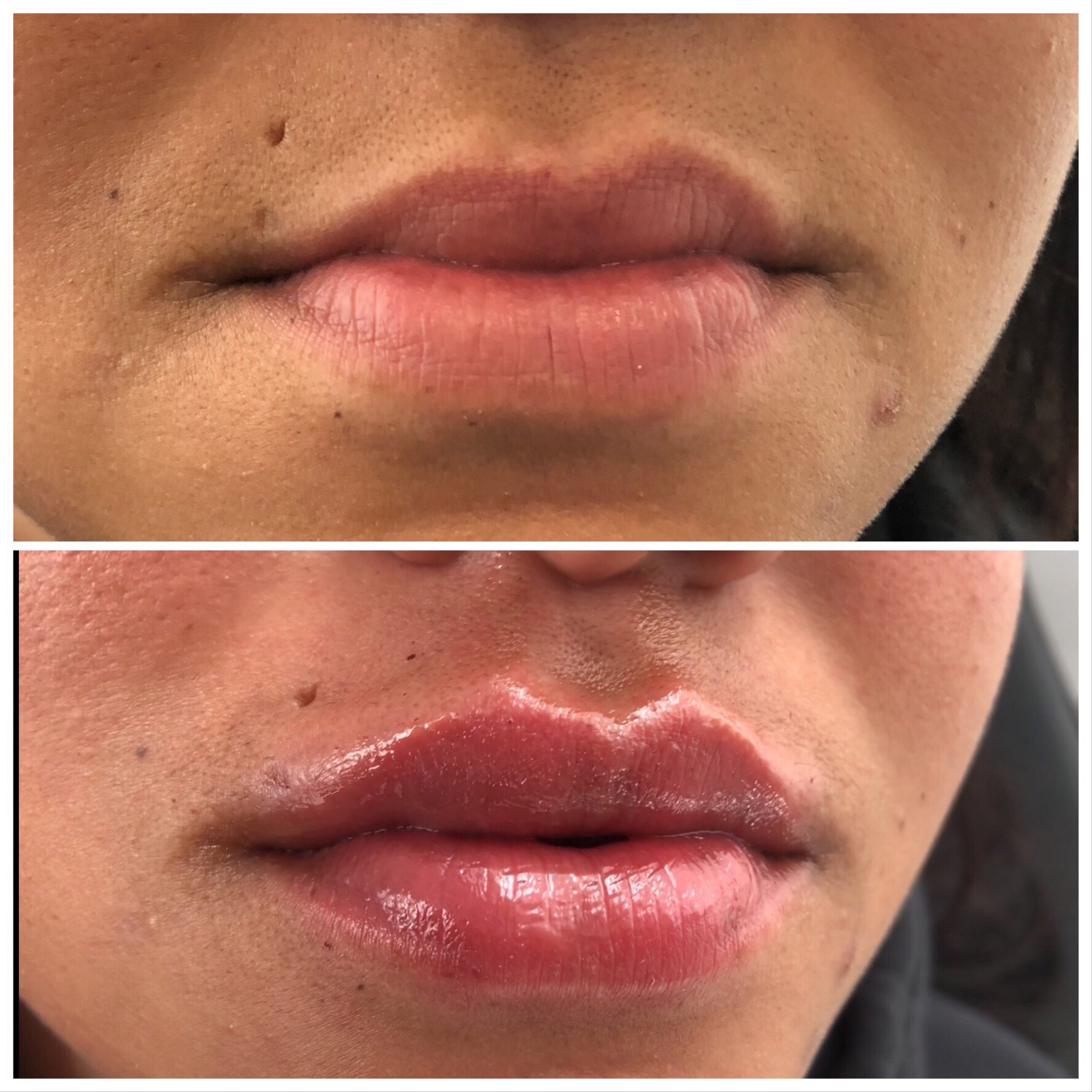 Lips Before & After Photos Dr. Hardik Doshi