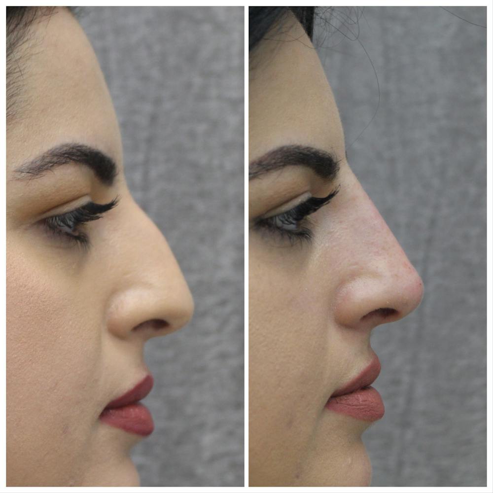 Nose Gallery - Patient 108744872 - Image 2
