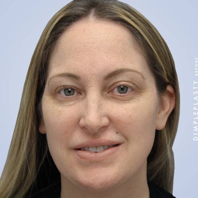 Dimpleplasty Before & After Gallery - Patient 117573292 - Image 1