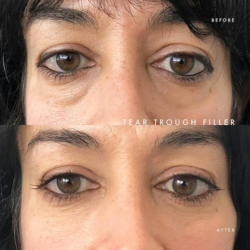 Eyes Before & After Gallery - Patient 117573332 - Image 1