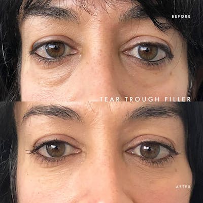 Non-Surgical Eyes Before & After Gallery - Patient 117573332 - Image 1