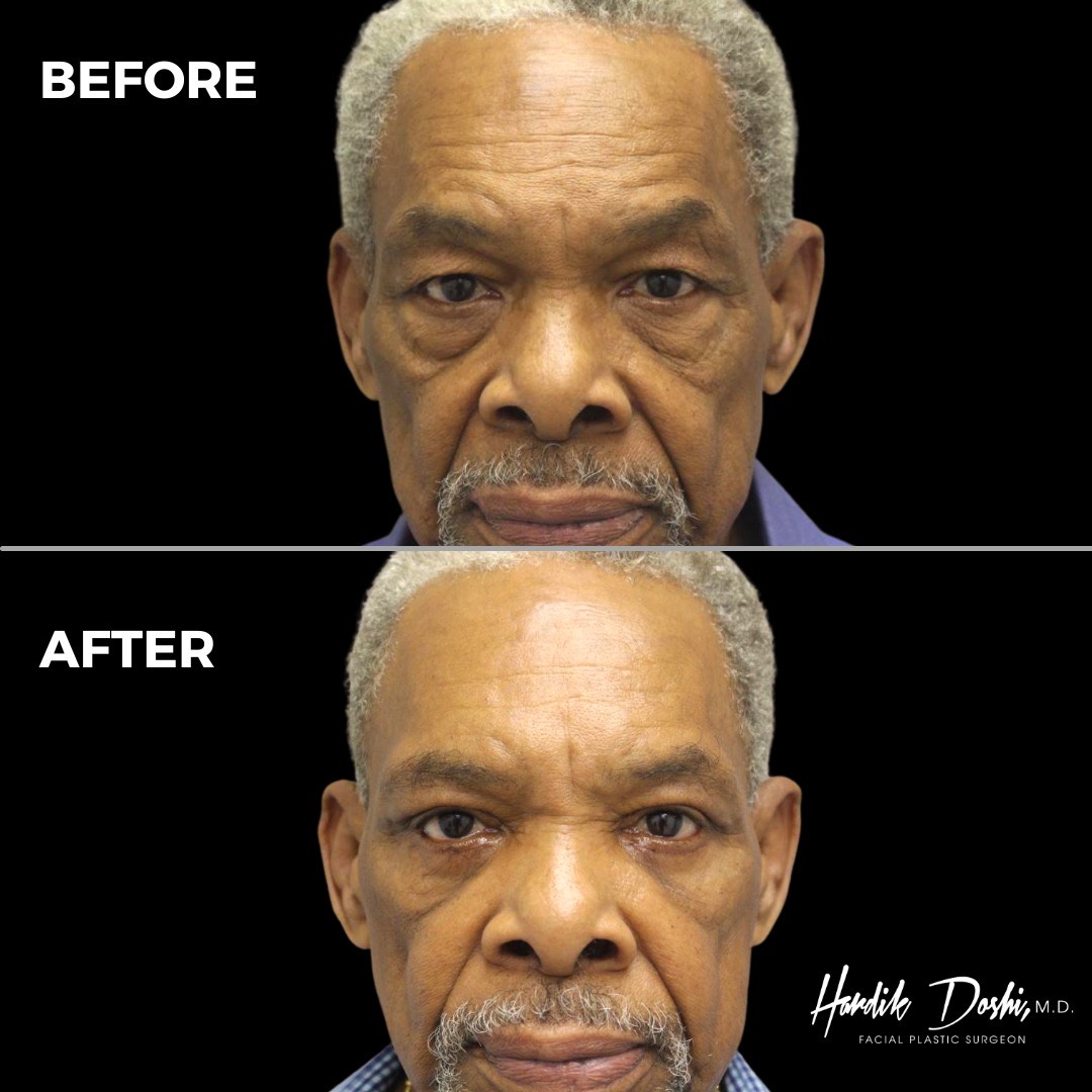 Eyes Before & After Photos Dr. Hardik Doshi