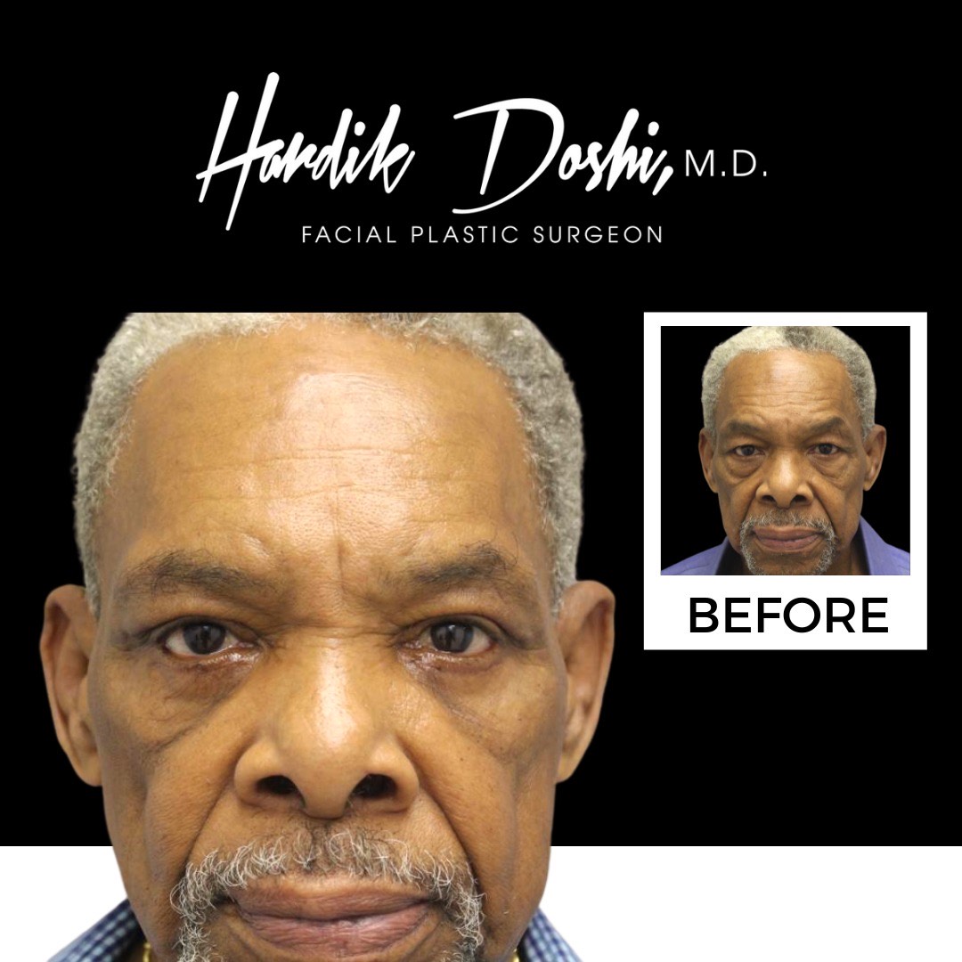 Eyes Before & After Photos Dr. Hardik Doshi