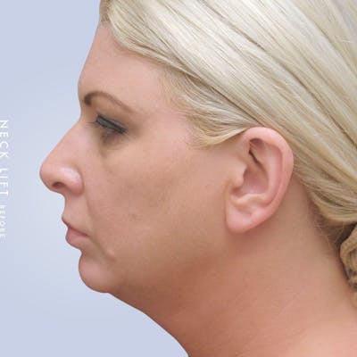 Face & Neck Before & After Gallery - Patient 117693229 - Image 1