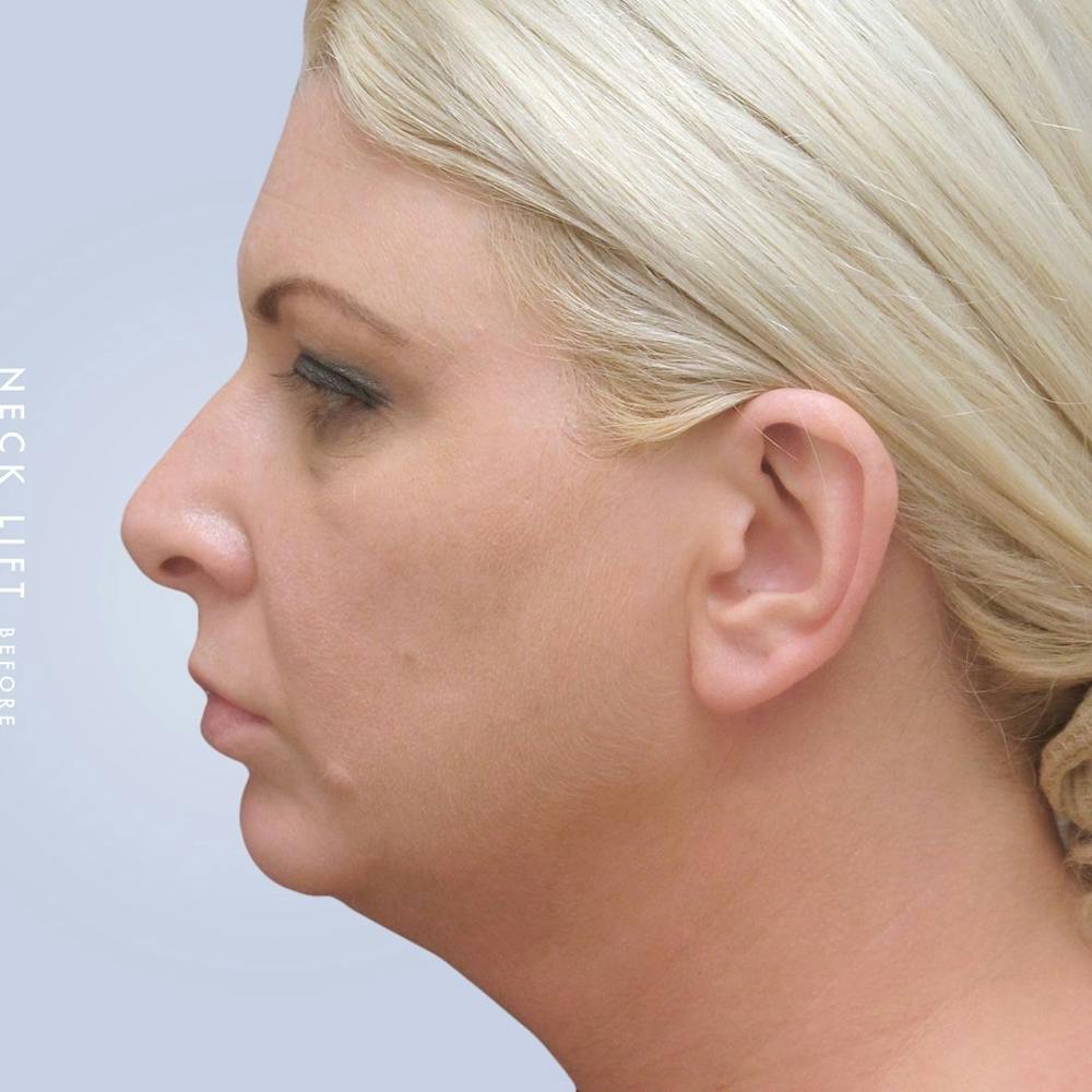 Face & Neck Before & After Gallery - Patient 117693229 - Image 1