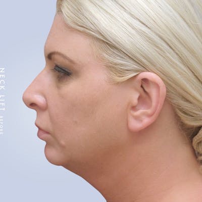 Face & Neck Gallery - Patient 117693229 - Image 1
