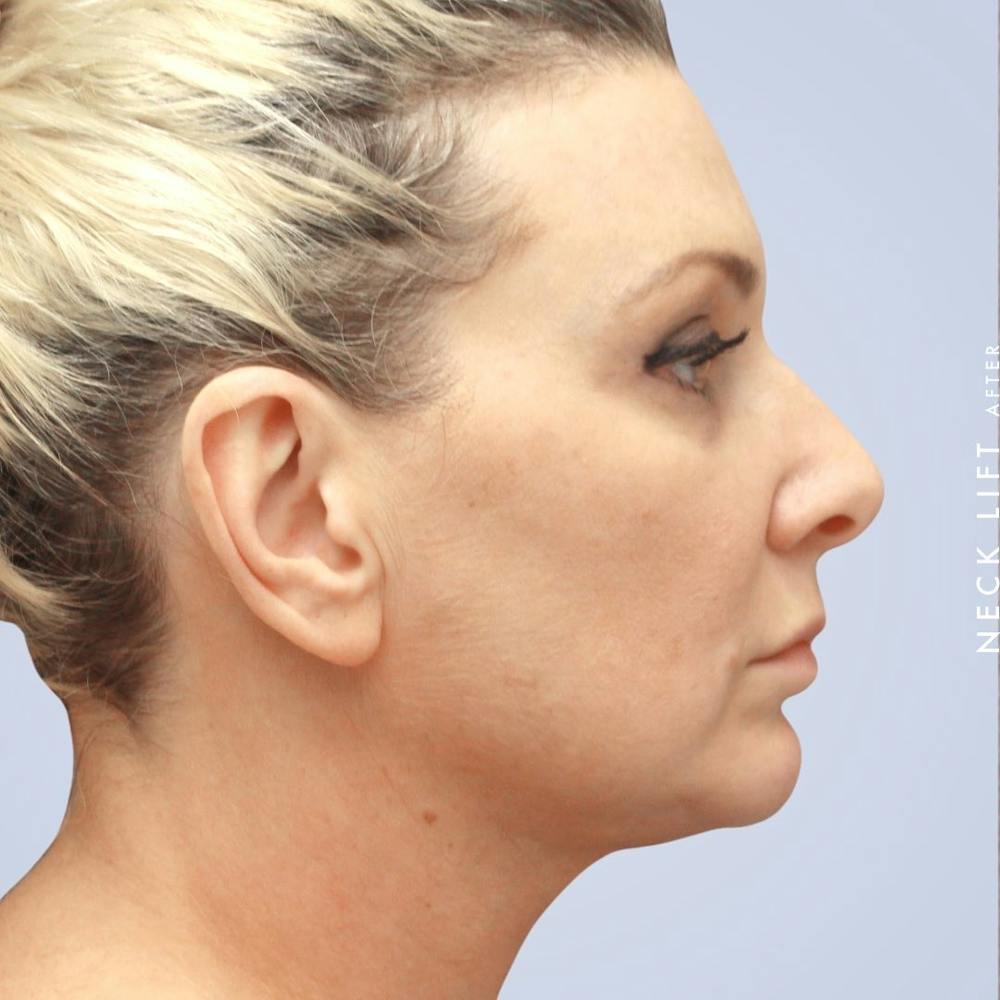 Face & Neck Before & After Gallery - Patient 117693229 - Image 6