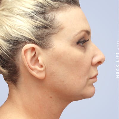 Face & Neck Before & After Gallery - Patient 117693229 - Image 6