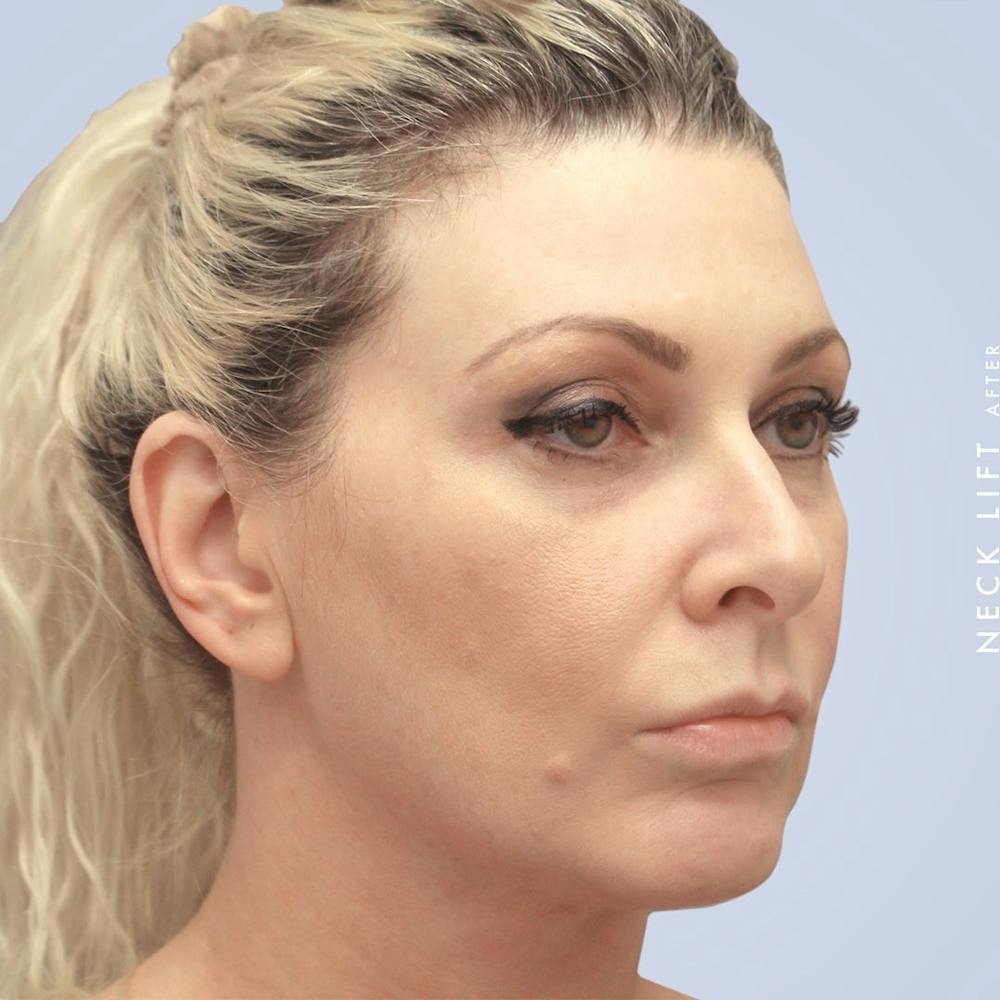 Face & Neck Before & After Gallery - Patient 117693229 - Image 4