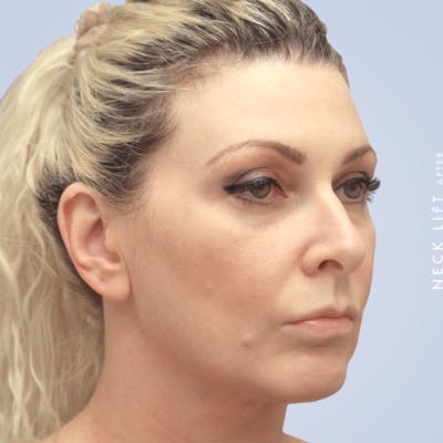 Face & Neck Before & After Gallery - Patient 117693229 - Image 4