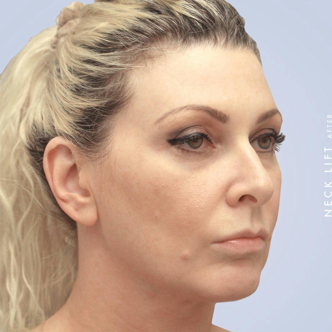 Face & Neck Before & After Gallery - Patient 117693229 - Image 4