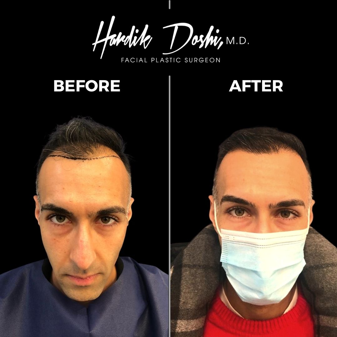 Hair Transplant results Long Island