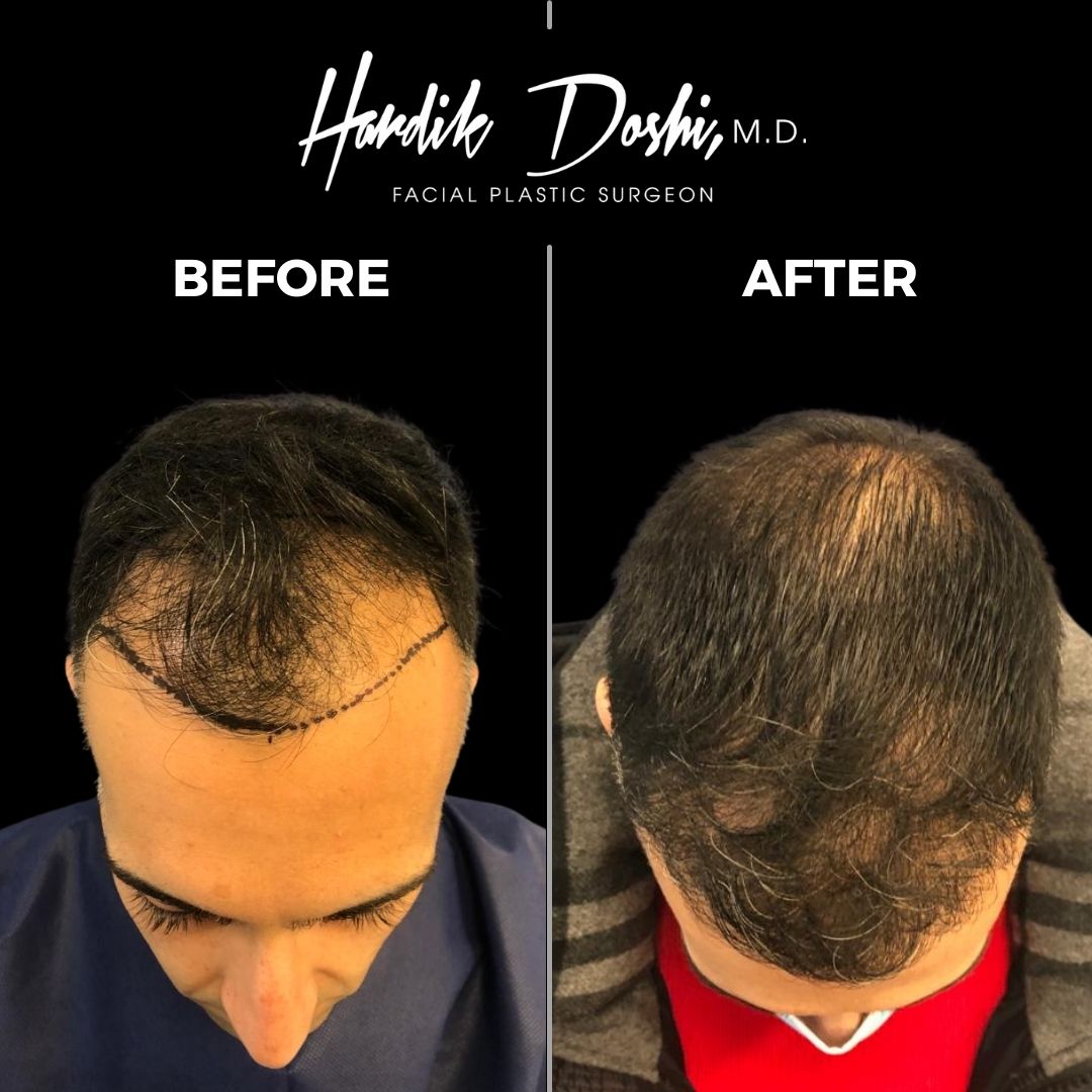 Results of Long Island Hair Transplant