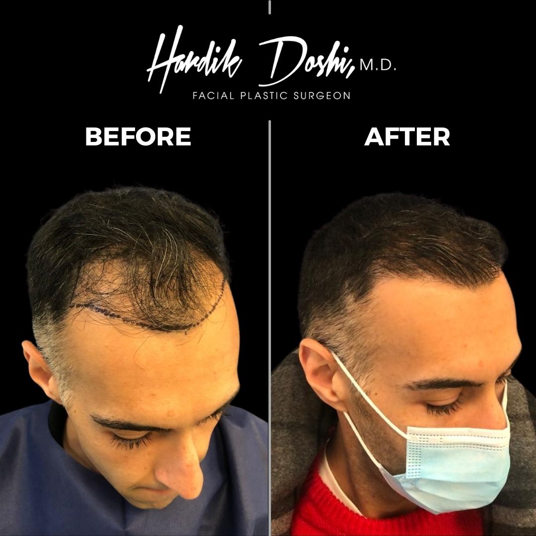 Hair Transplant in Long Island with Dr. Doshi