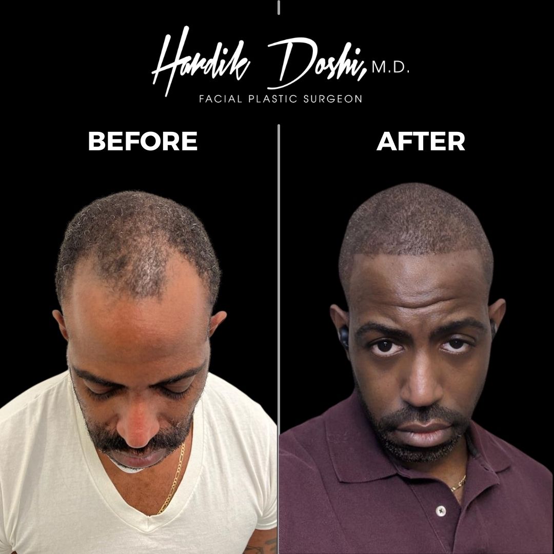 Hair Transplants in Long Island