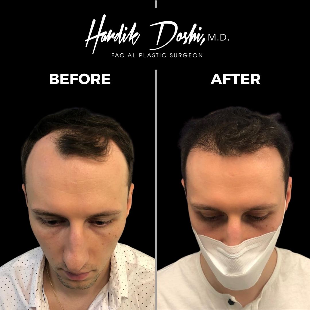Hair Transplant in Long Island by Dr. Doshi