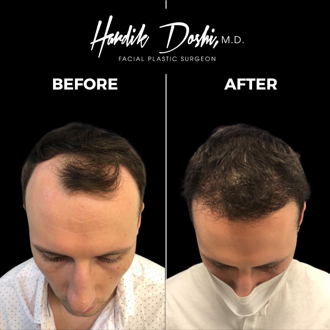 Long Island Hair Transplant