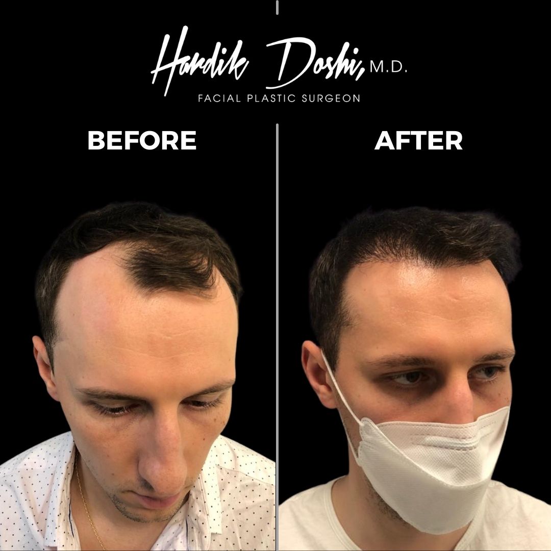 Hair Transplant Long Island