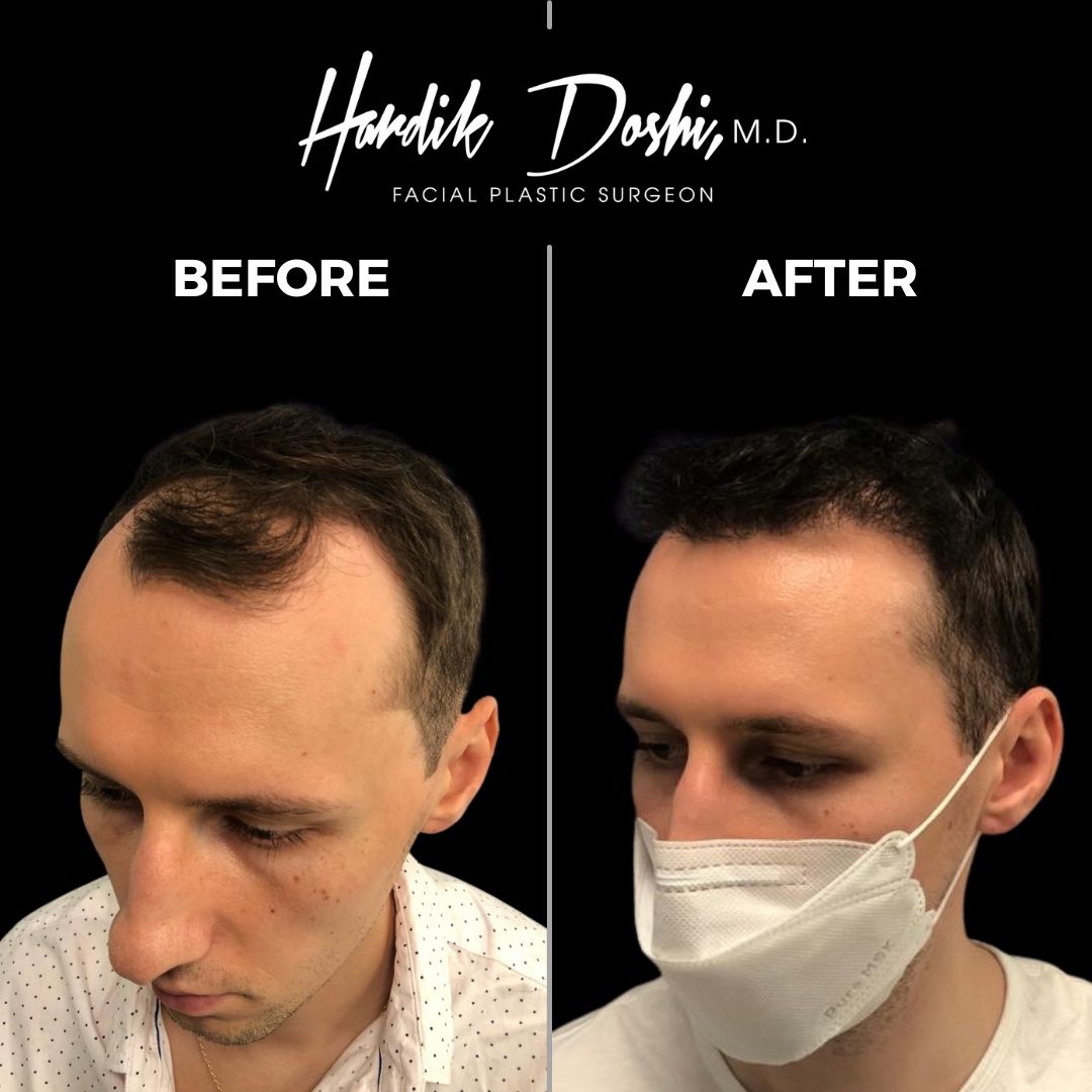 Dr. Doshi's Long Island Hair Transplant