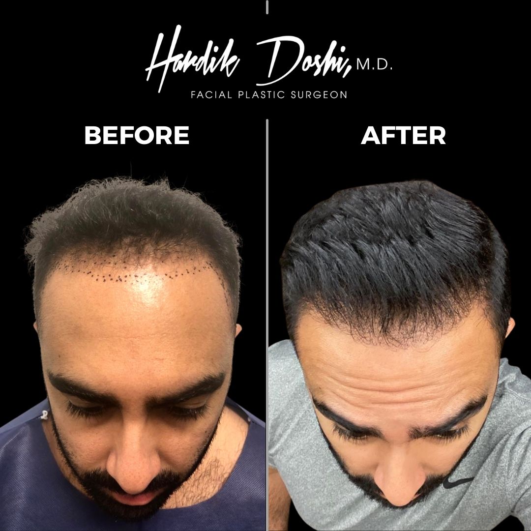 Hair Transplant Long Island | Best Hair Transplant Dr. Doshi