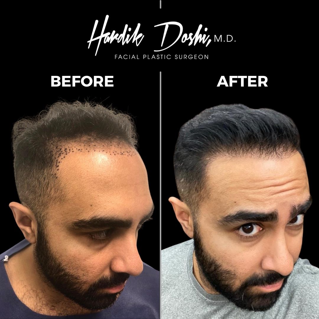 Hair Transplant by Dr. Doshi in Long Island