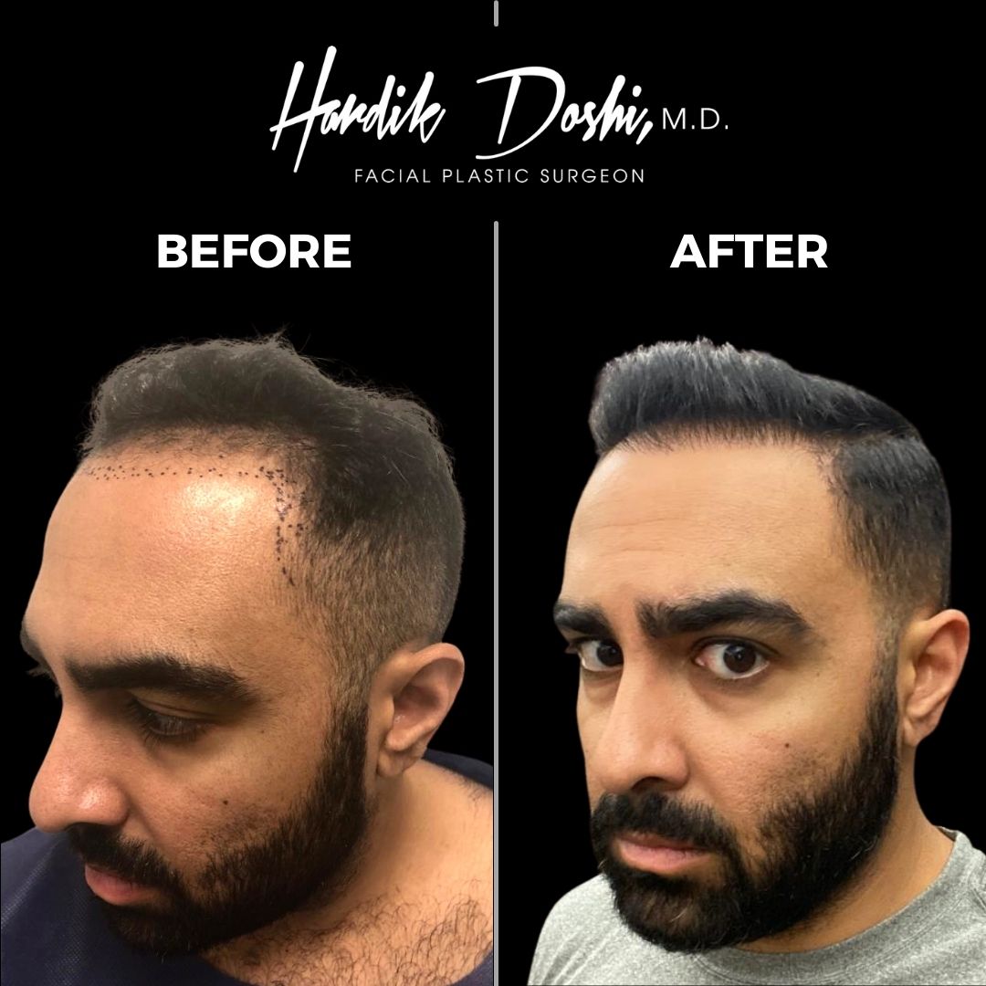 Hair Transplant before and after by Dr. Doshi