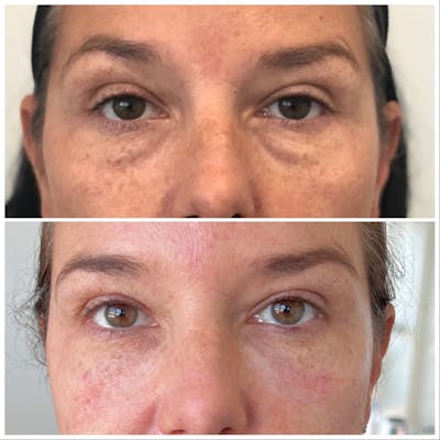 Non-Surgical Eyes Before & After Gallery - Patient 121439069 - Image 1