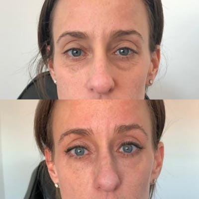 Non-Surgical Eyes Before & After Gallery - Patient 121439078 - Image 1