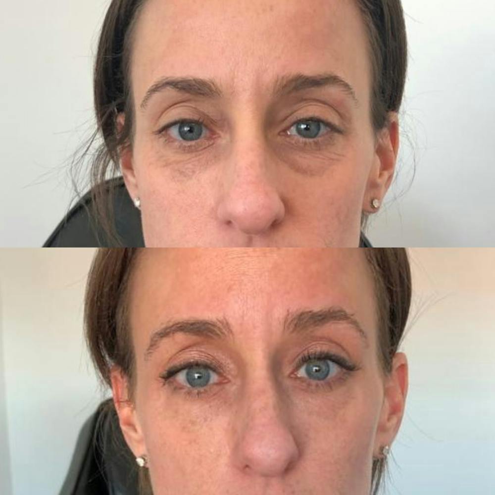 Eyes Before & After Gallery - Patient 121439078 - Image 1