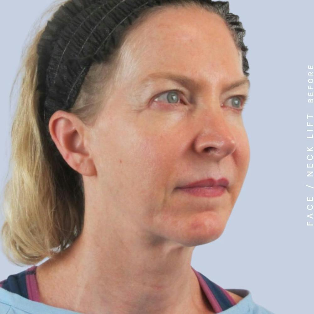 Face & Neck Before & After Gallery - Patient 120868608 - Image 3