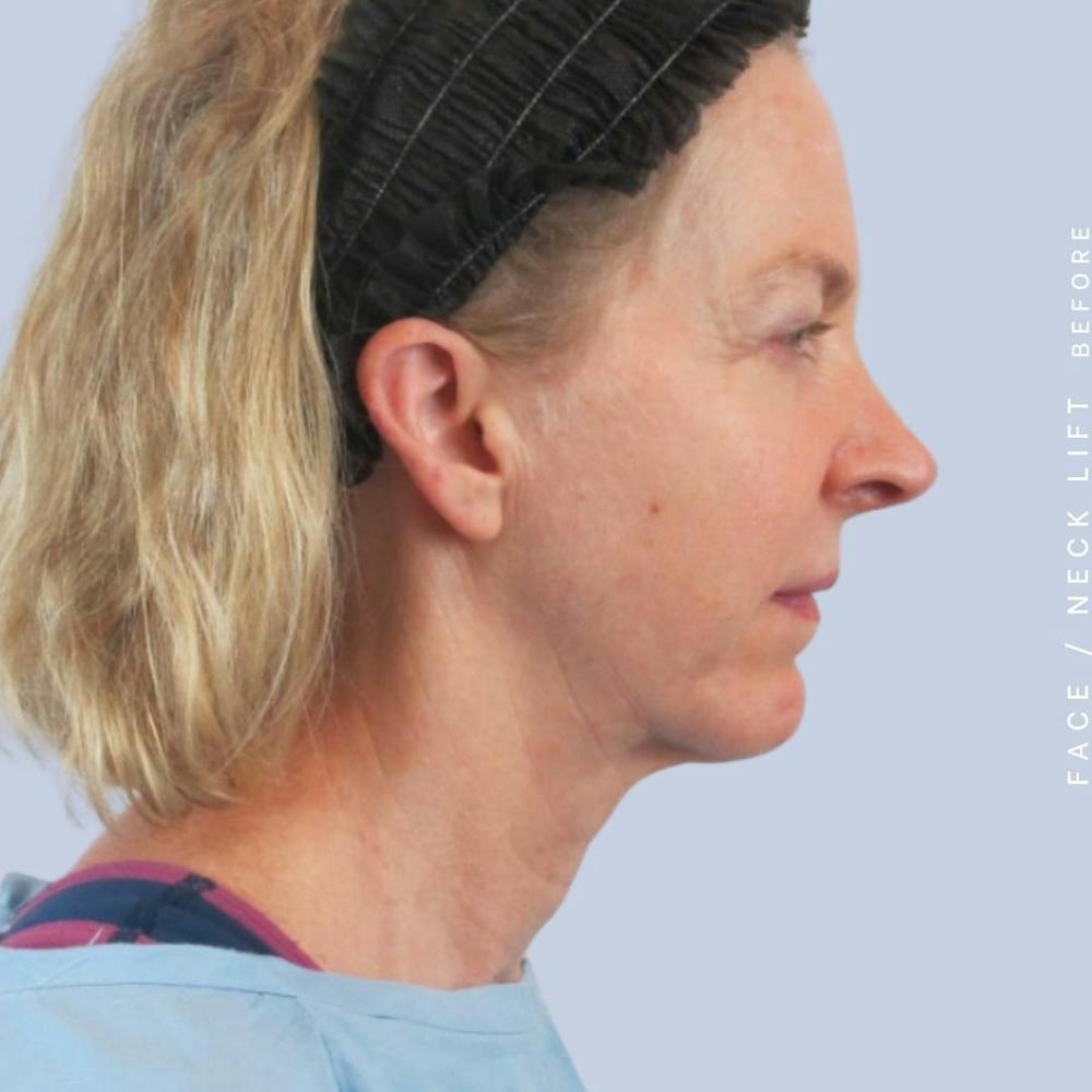 Face & Neck Before & After Gallery - Patient 120868608 - Image 5
