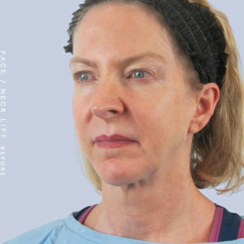 Face & Neck Before & After Gallery - Patient 120868608 - Image 7