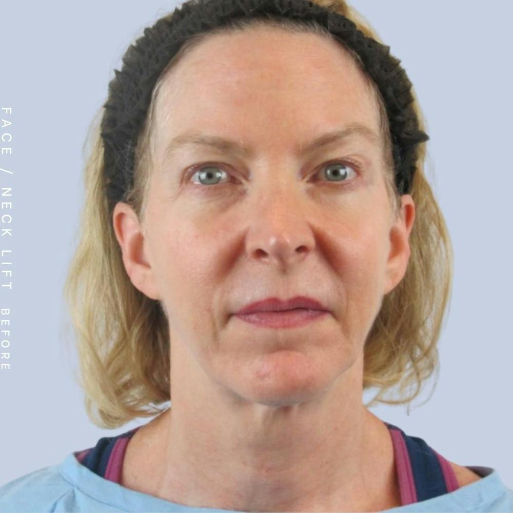 Face & Neck Before & After Gallery - Patient 120868608 - Image 1