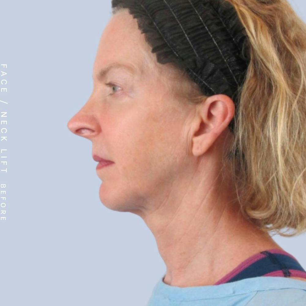 Face & Neck Before & After Gallery - Patient 120868608 - Image 9