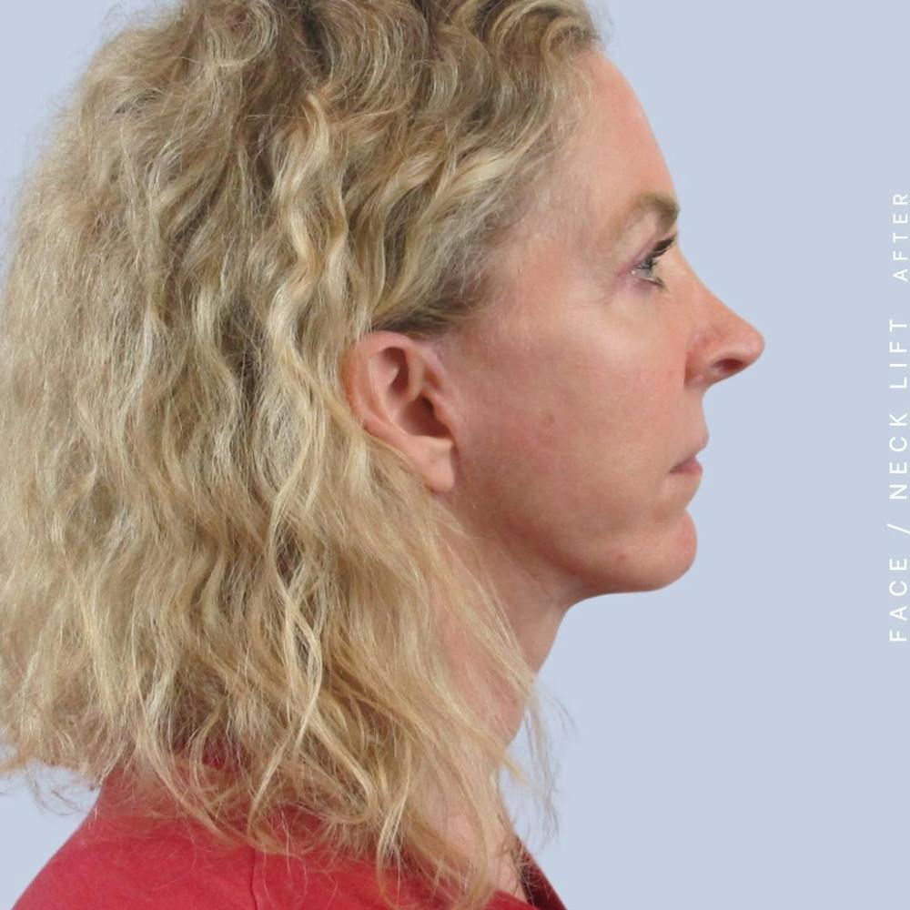 Face & Neck Before & After Gallery - Patient 120868608 - Image 6