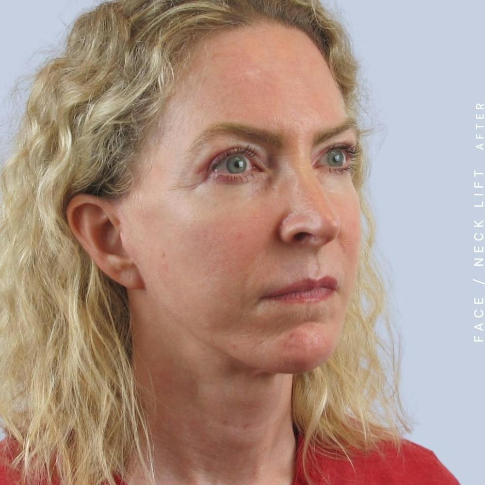 Face & Neck Before & After Gallery - Patient 120868608 - Image 4