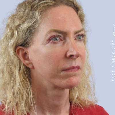Face & Neck Before & After Gallery - Patient 120868608 - Image 4