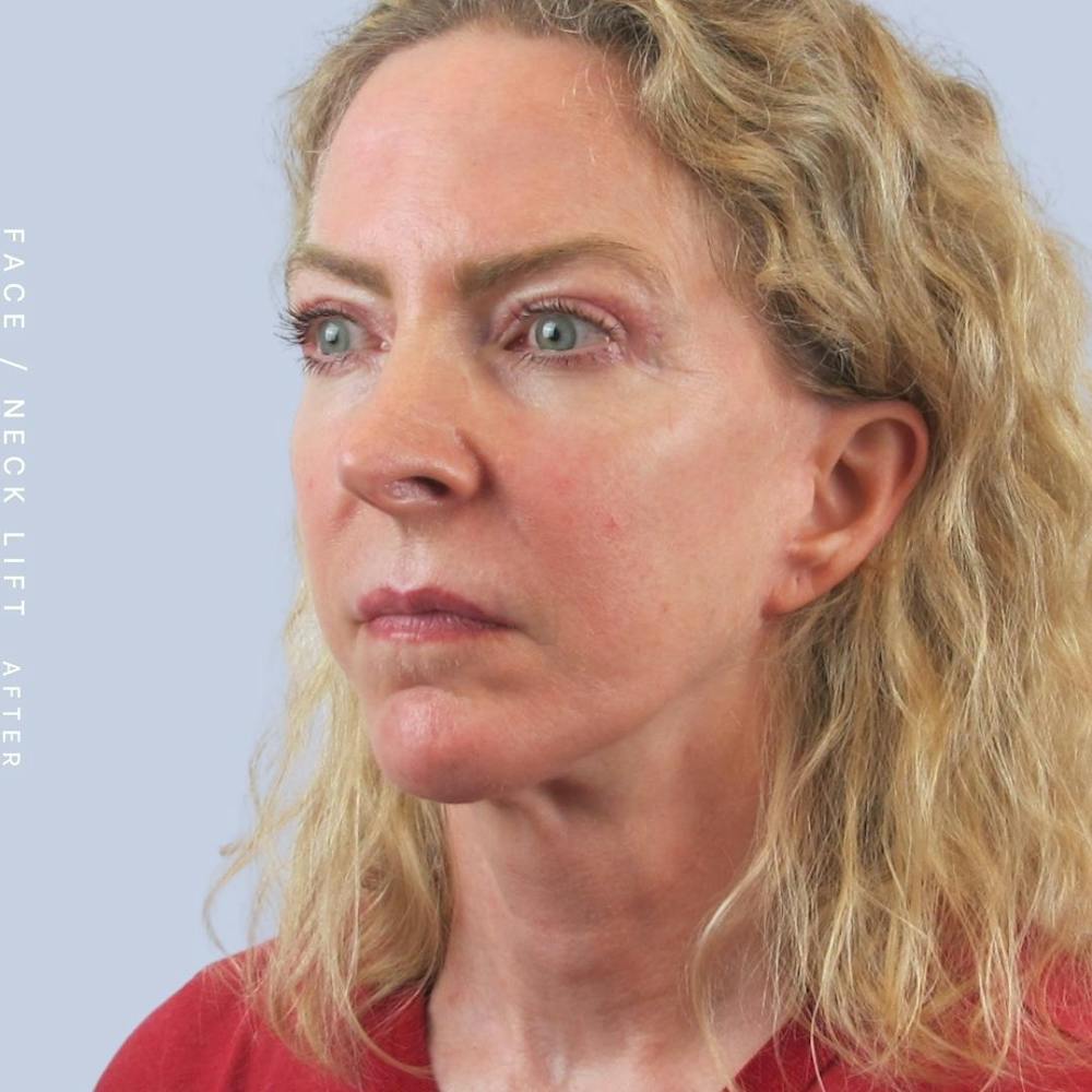 Face & Neck Before & After Gallery - Patient 120868608 - Image 8