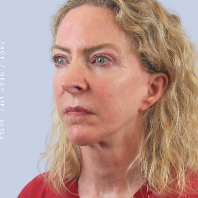 Face & Neck Before & After Gallery - Patient 120868608 - Image 8