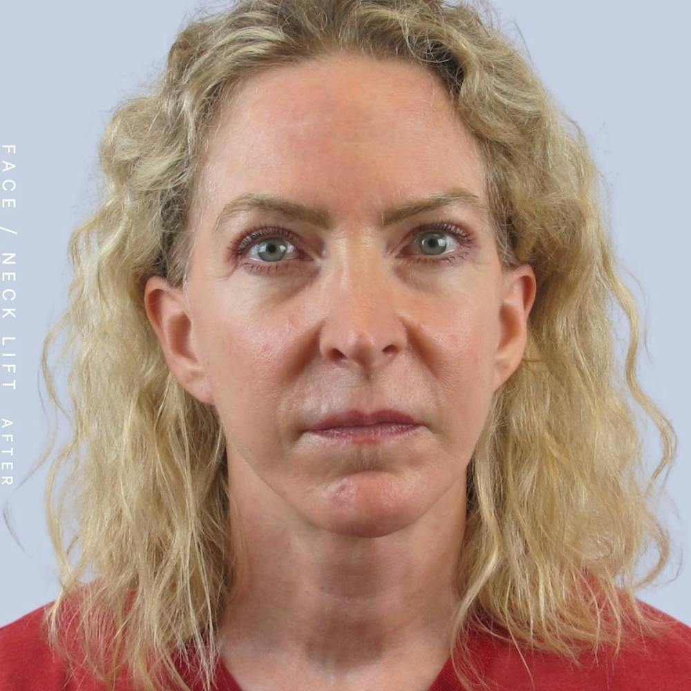 Face & Neck Before & After Gallery - Patient 120868608 - Image 2
