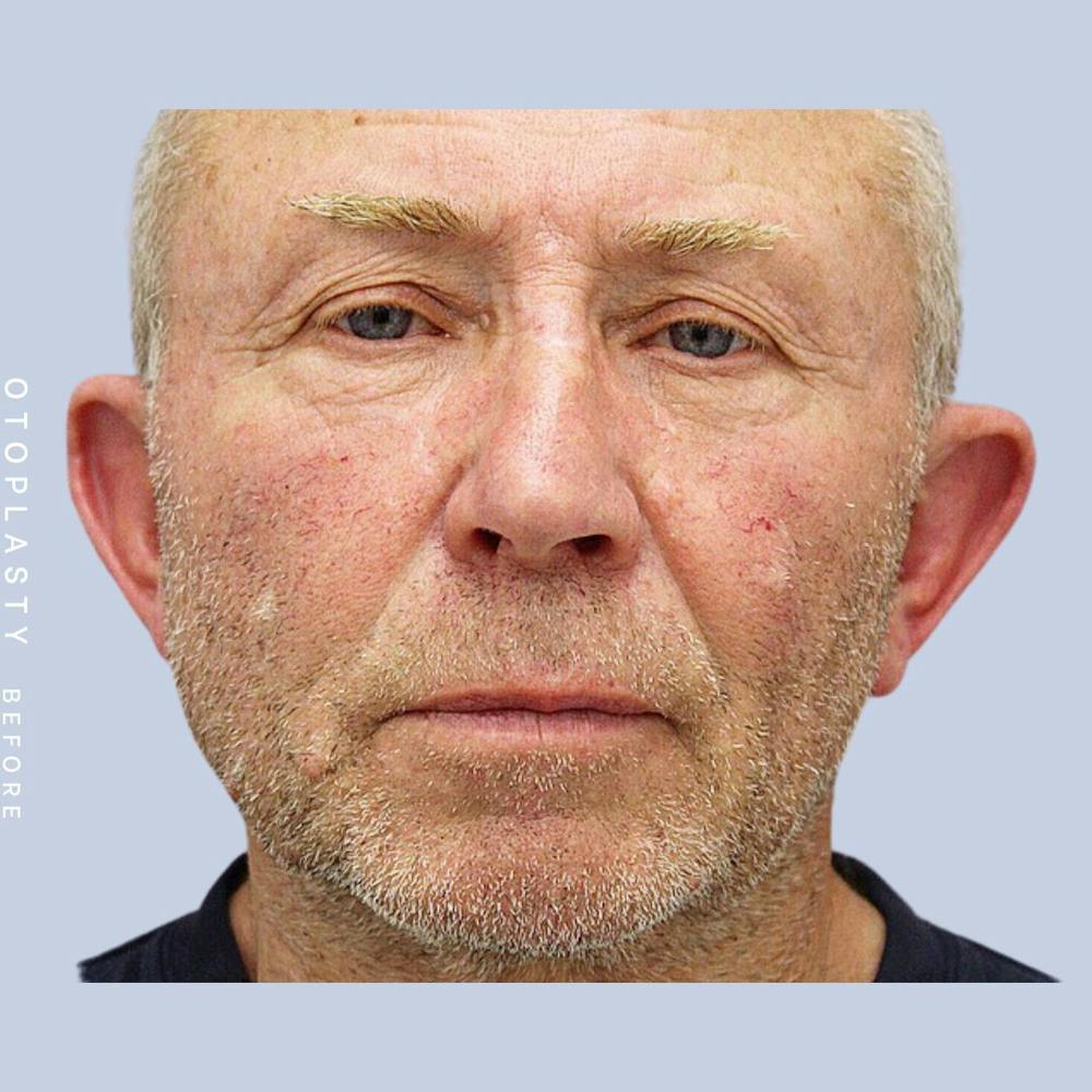 Ears Before & After Gallery - Patient 108744089 - Image 1