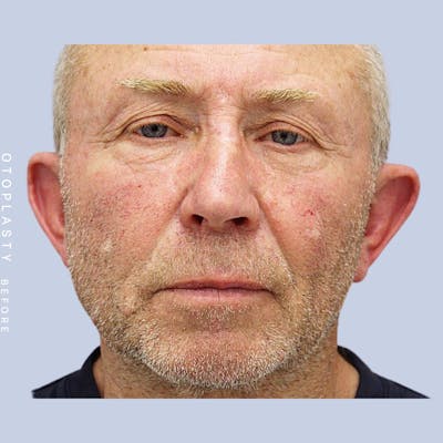 Ears Before & After Gallery - Patient 108744089 - Image 1