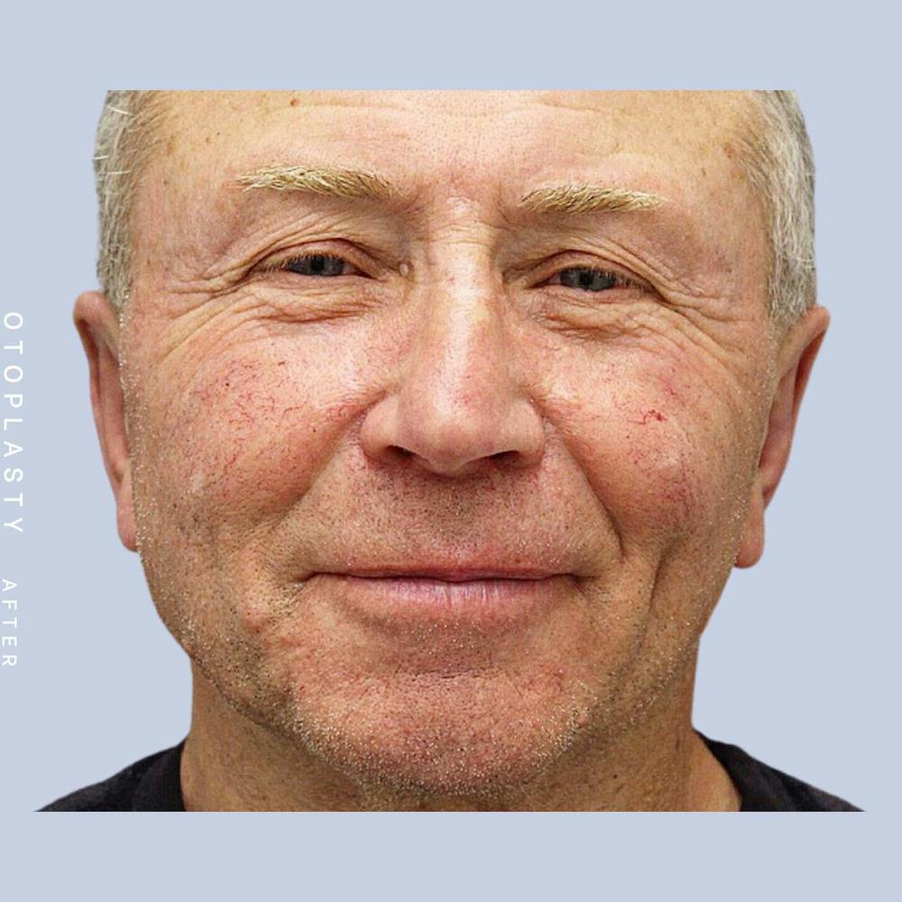 Ears Before & After Gallery - Patient 108744089 - Image 2