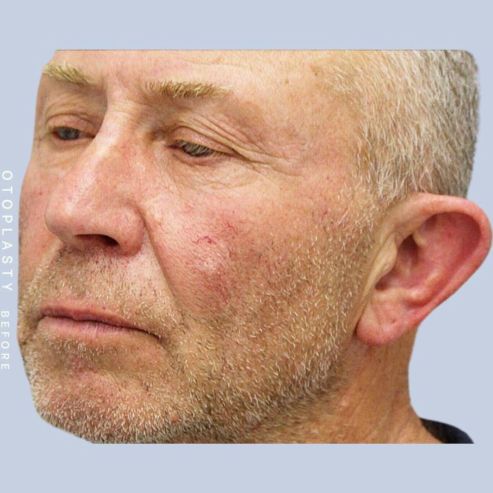 Ears Before & After Gallery - Patient 108744089 - Image 3
