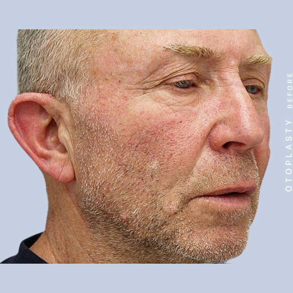 Ears Before & After Gallery - Patient 108744089 - Image 5