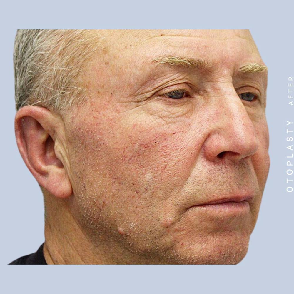 Ears Before & After Gallery - Patient 108744089 - Image 6