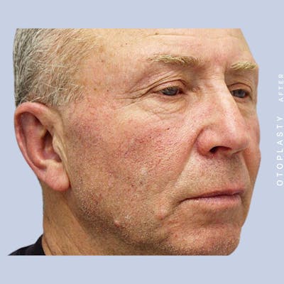 Ears Before & After Gallery - Patient 108744089 - Image 6